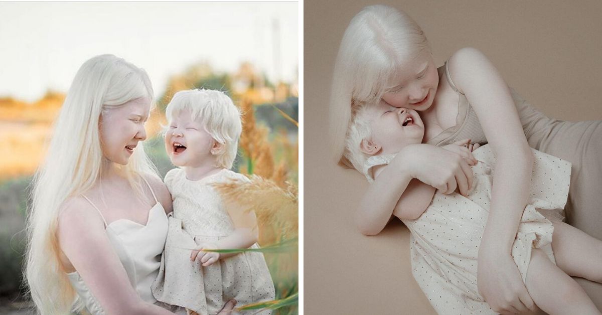 Albino Sisters Born 12 Years Apart Attracting Attention As Models