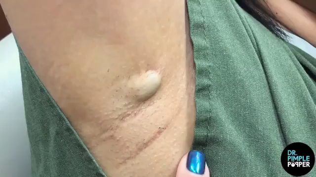 Dr Pimple Popper Watch This Painful Looking Armpit Cyst Open Up Like A Blooming Flower