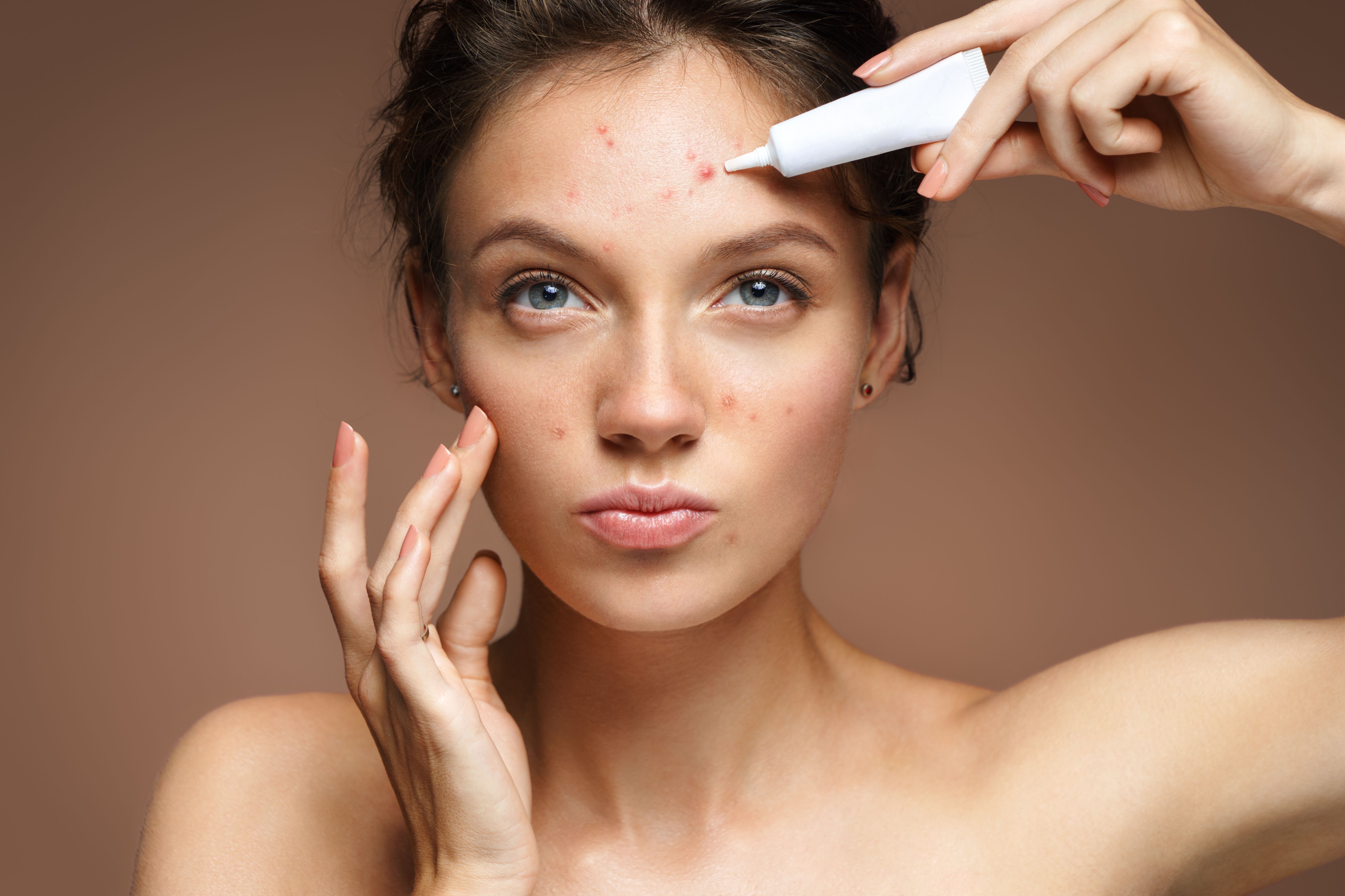 Young woman applies topical treatment to her forehead acne. 