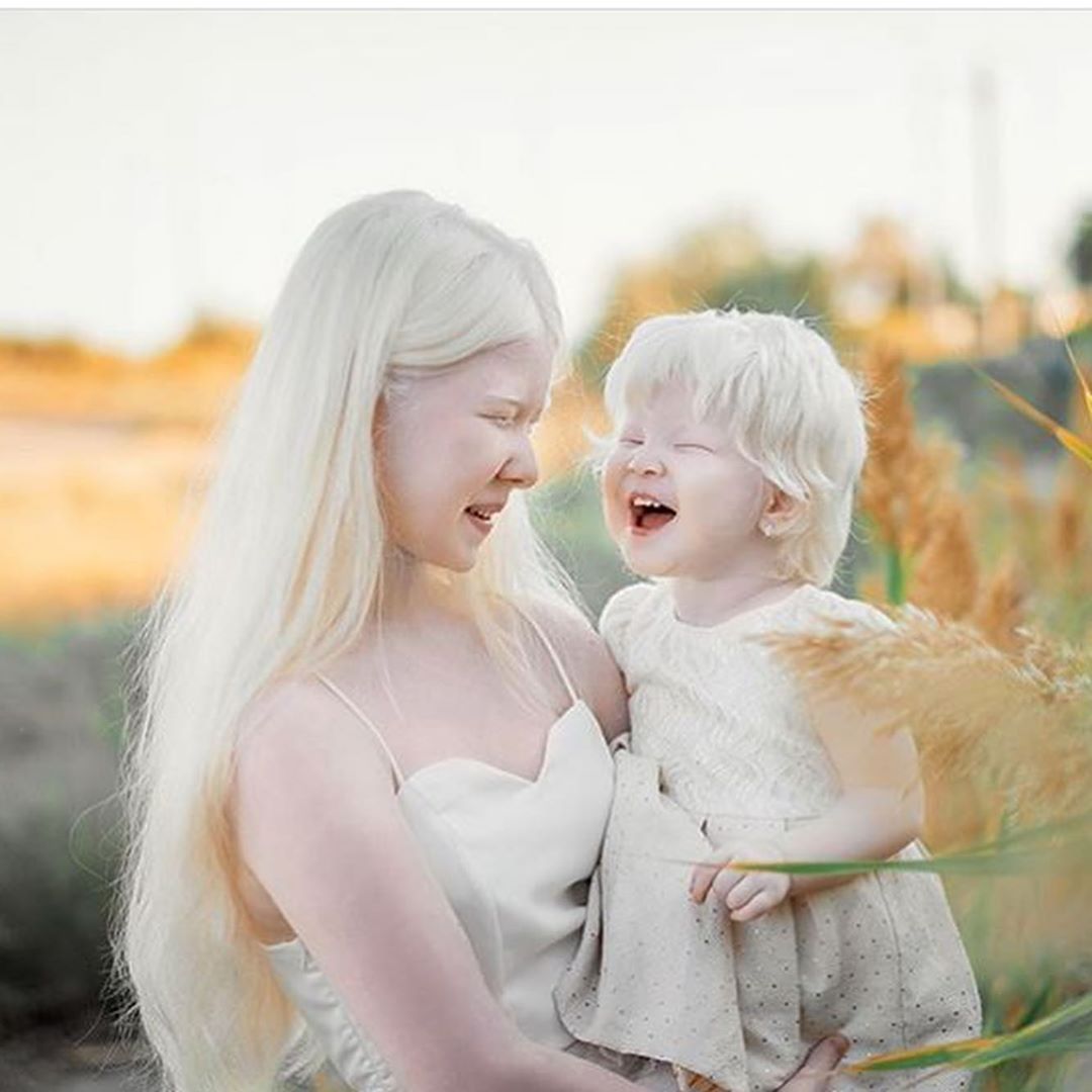 Albino Sisters Born 12 Years Apart Attracting Attention As Models