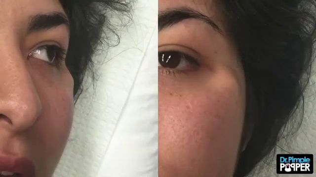 Dr Pimple Popper Watch The Cottage Cheese Explode Out Of