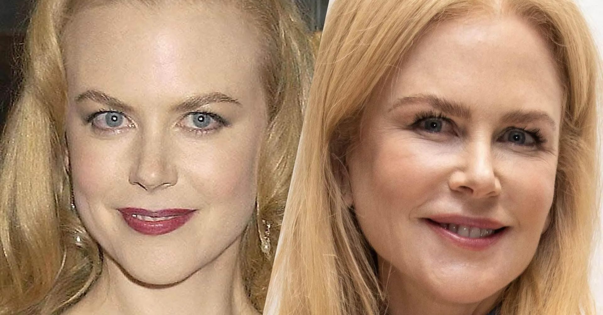 'The Undoing' Star Nicole Kidman's Fresh Face, Plastic Surgeons Weigh In
