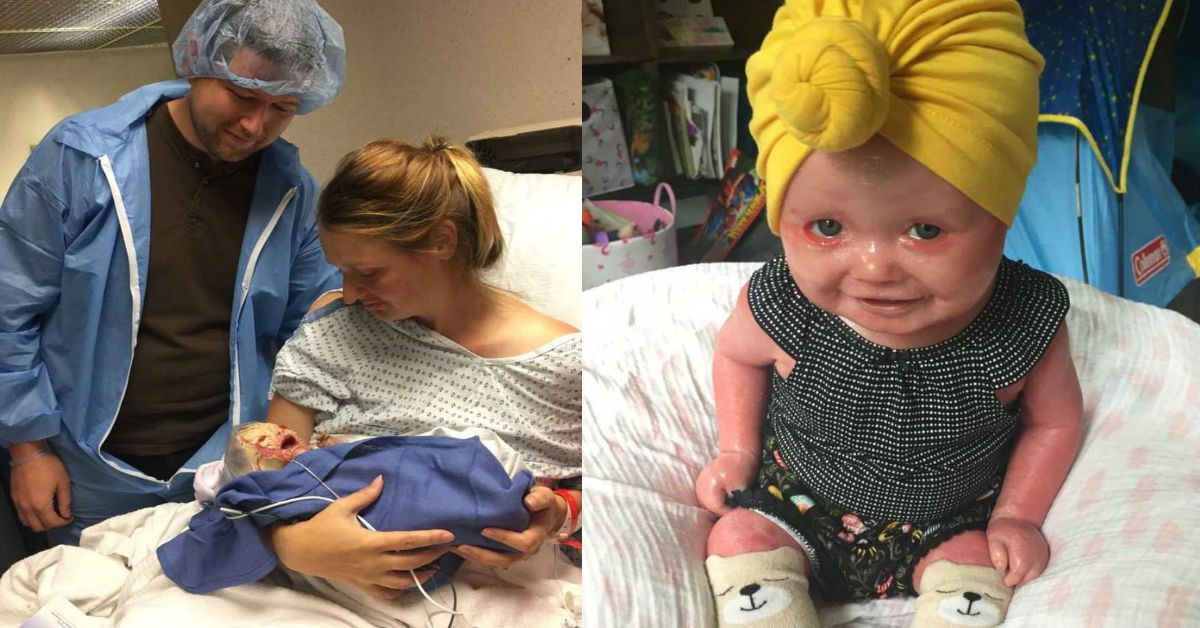 Photos Reveal Baby's Skin Hardened and Split Seconds After ...